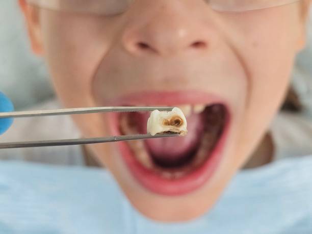 Best Emergency Treatment for Dental Infections or Abscesses in Grand Rapids, MI
